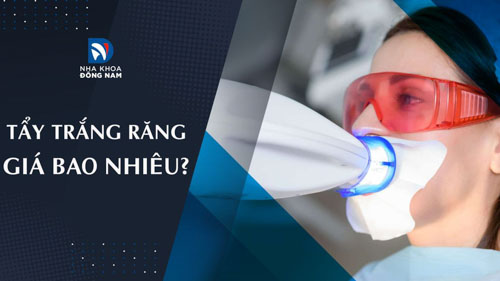 Tẩy trắng răng giá bao nhiêu?