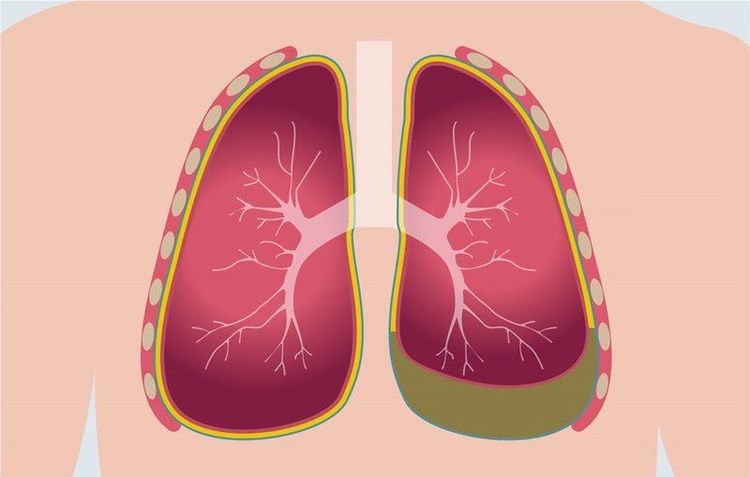 Bệnh nhân tràn dịch màng phổi được chỉ định xét nghiệm LDH