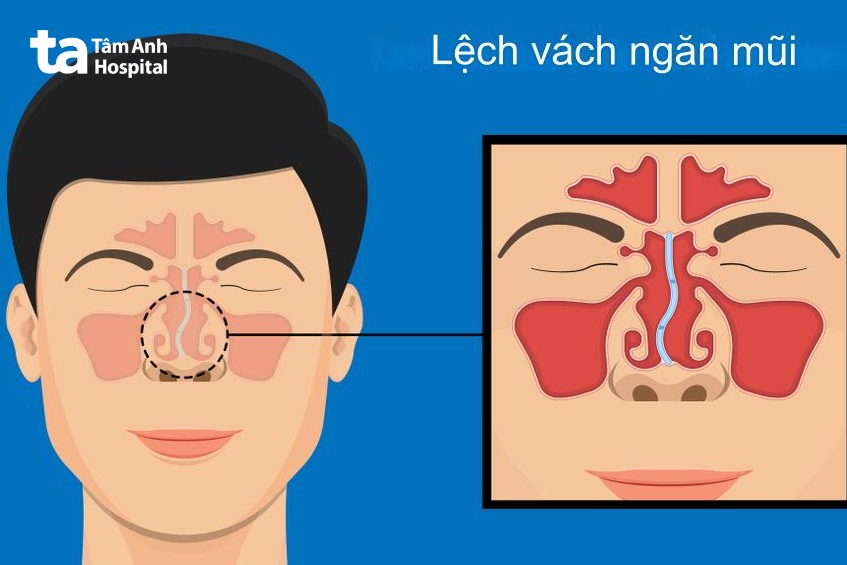 phẫu thuật chỉnh hình vách ngăn mũi