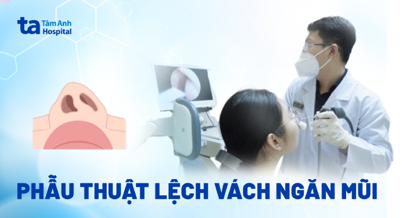 phẫu thuật lệch vách ngăn mũi