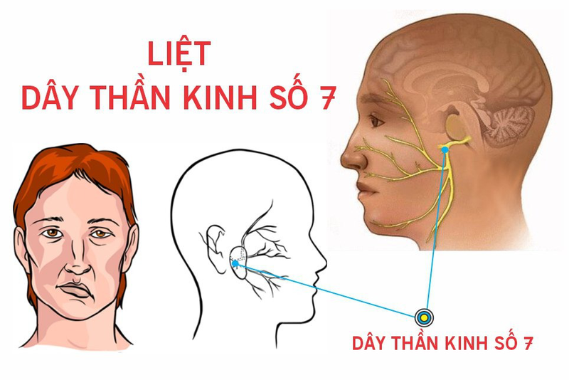 Mặt lệch bên cao bên thấp: Nguyên nhân và cách điều trị hiệu quả 2