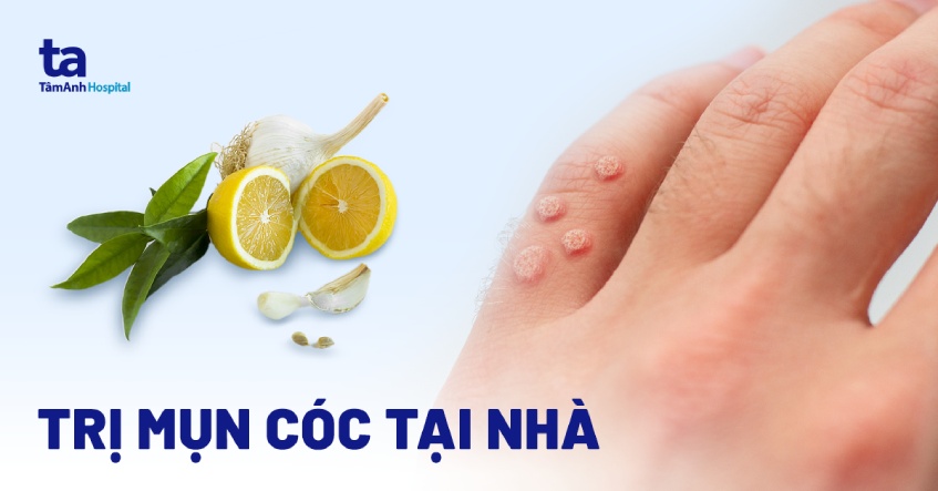 cách trị mụn cóc tại nhà