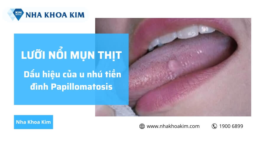 Lưỡi nổi mụn thịt là dấu hiệu của bệnh u nhú tiền đình Papillomatosis