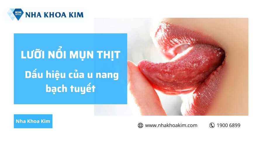 Lưỡi nổi mụn thịt là dấu hiệu của bệnh u nang bạch tuyết