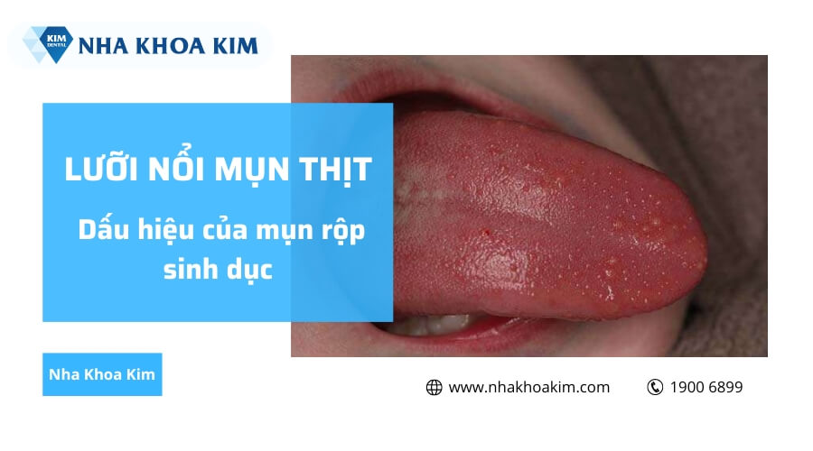 Lưỡi nổi mụn thịt là dấu hiệu của bệnh mụn rộp sinh dục