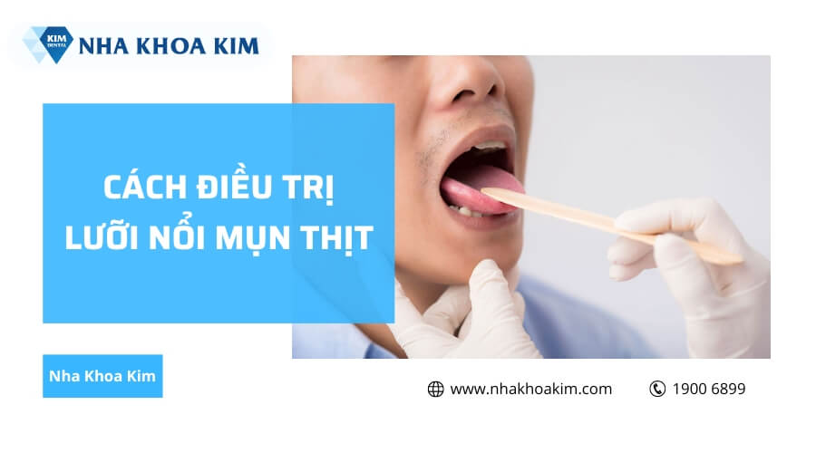 Cách điều trị lưỡi nổi mụn thịt