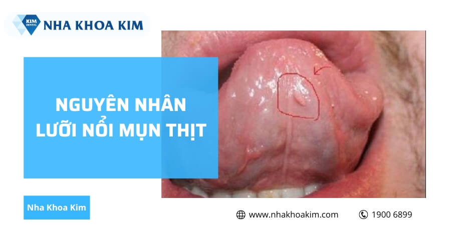 Nguyên nhân lưỡi nổi mụn thịt