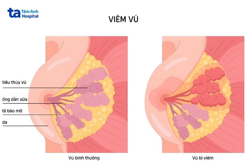 ngực ấn vào bị đau