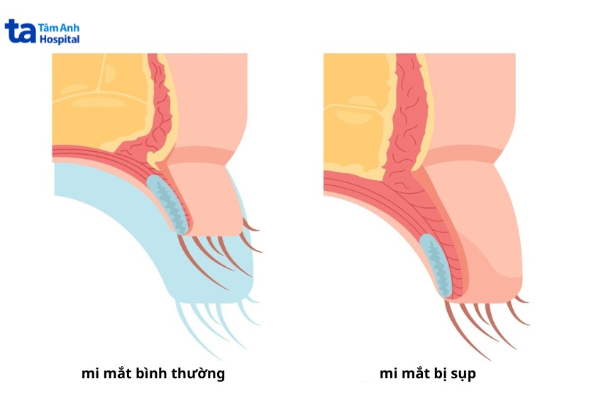 hình ảnh mí mắt bị sụp