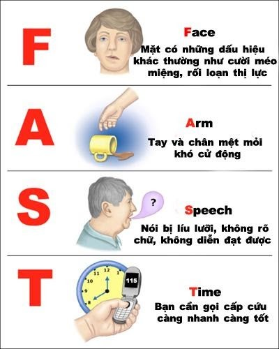 Cách nhận biết đột quỵ