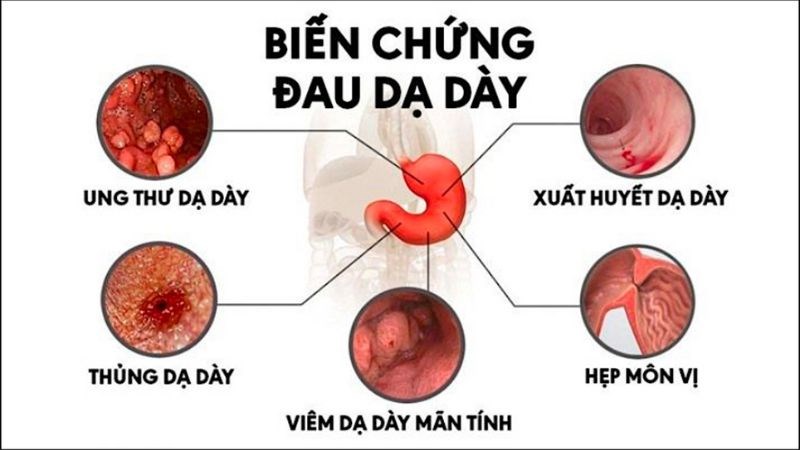 Viêm loét dạ dày - tá tràng gây ra nhiều biến chứng nghiêm trọng