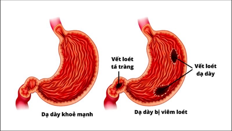 Vị trí loét có thể xảy ra ở dạ dày hoặc tá tràng