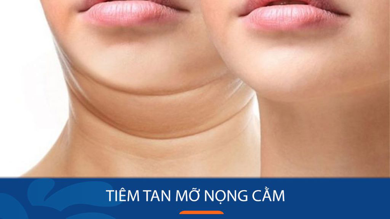 Phương pháp tiêm tan mỡ nọng cằm: Cơ chế, quá trình thực hiện và tác dụng phụ 2