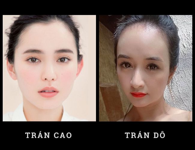 Cách phân biệt trán dô và trán cao