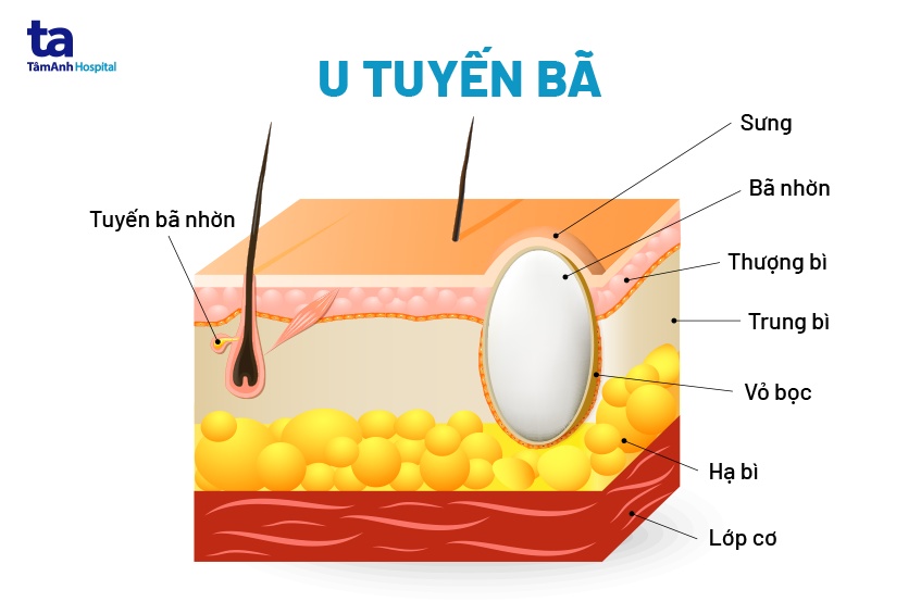 u nang bã đậu là gì