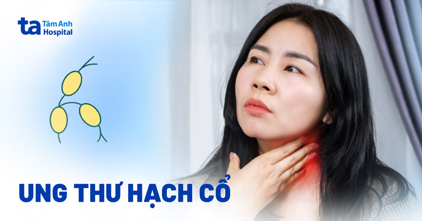 ung thư hạch cổ