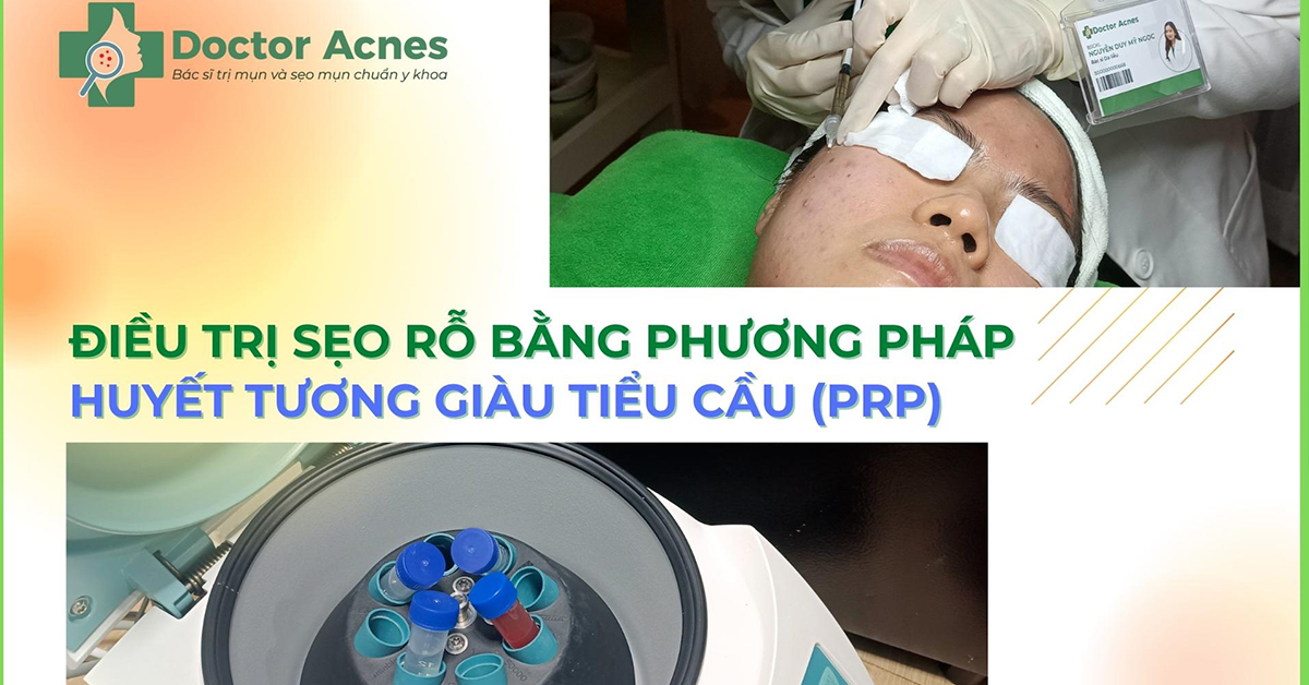 Khách hàng trị sẹo rỗ tại Phòng khám da liễu Táo Đỏ