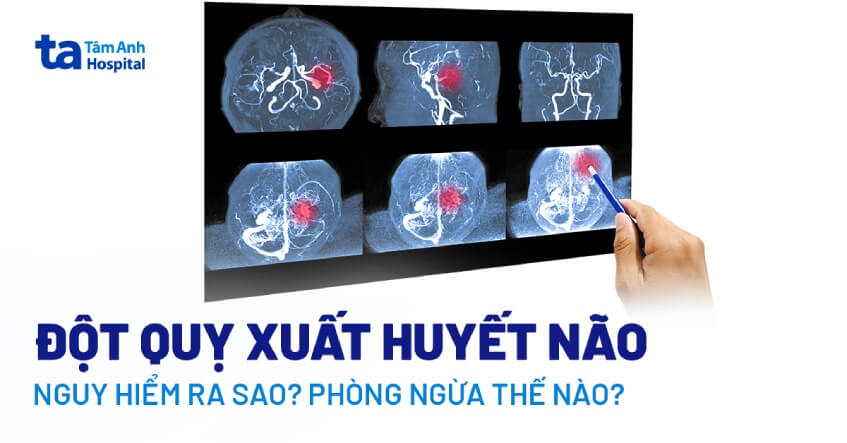 đột quỵ xuất huyết não