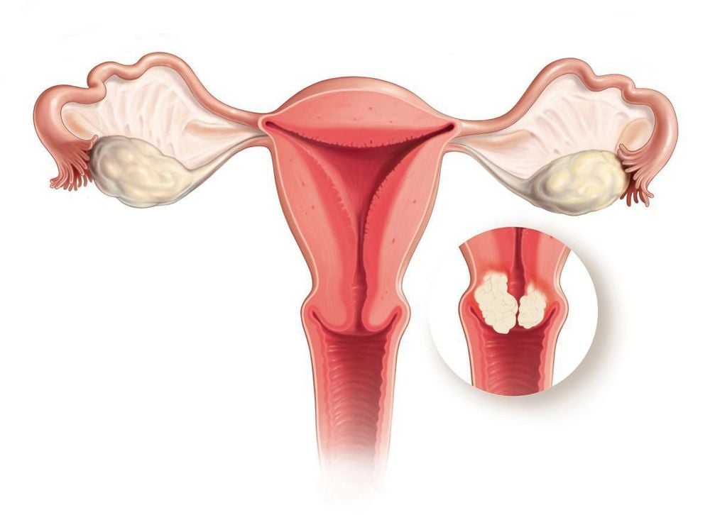 Virus HPV gây ra lở loét, nguy cơ dẫn đến ung thư cổ tử cung