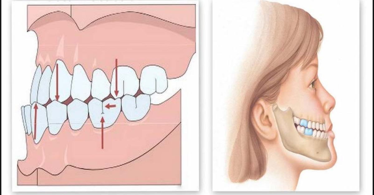 Trường hợp răng hô, khớp cắn hở nghiêm trọng nên thực hiện niềng răng