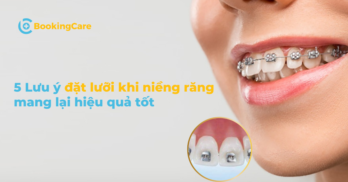 5 Lưu ý đặt lưỡi khi niềng răng mang lại hiệu quả tốt