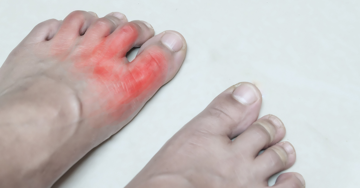 Nên ăn và tránh ăn gì khi bị bệnh gout