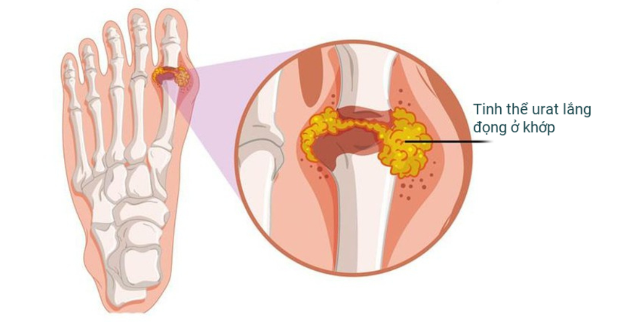 Triệu chứng bệnh gout