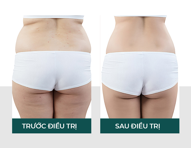 Khách hàng trước và sau khi sử dụng liệu trình Body Contour