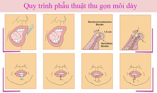 Con trai môi dày xấu hay đẹp