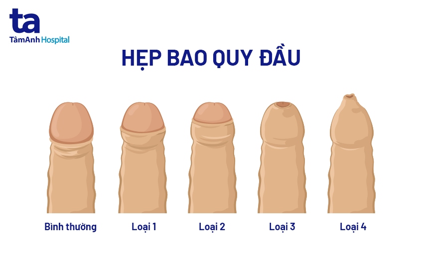 hẹp bao quy đầu