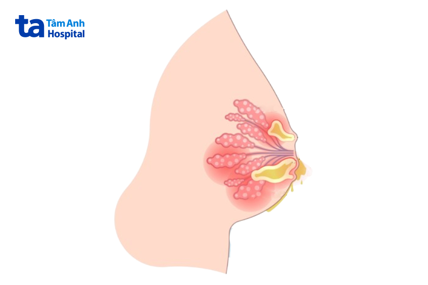 triệu chứng của ung thư vú