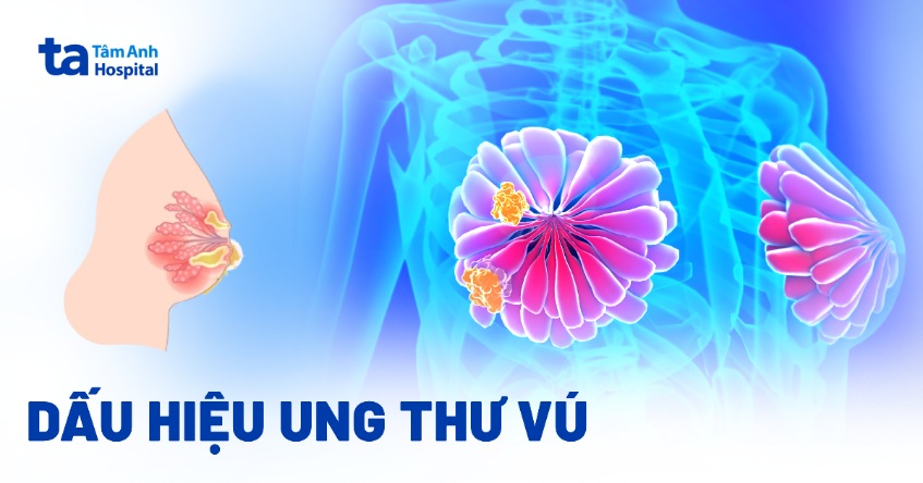 dấu hiệu ung thư vú