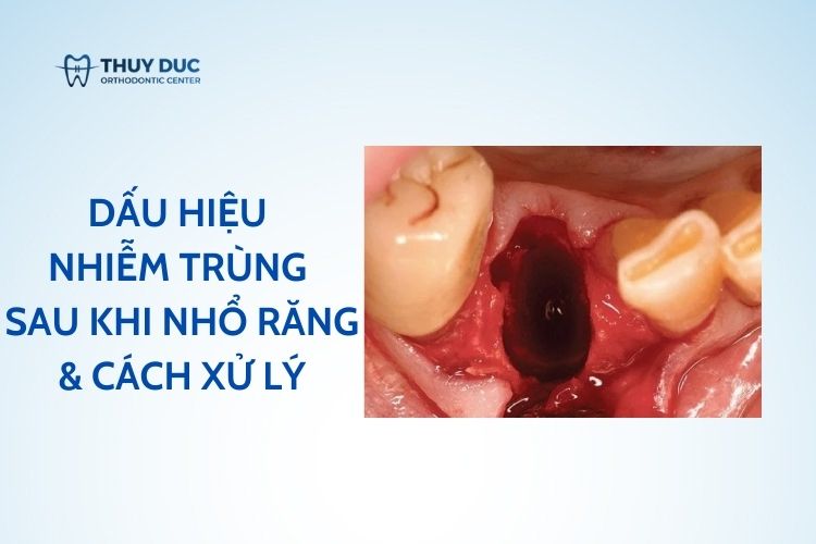 Dấu hiệu nhiễm trùng sau khi nhổ răng và cách xử lý 1