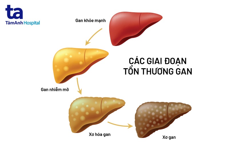 triệu chứng bệnh gan