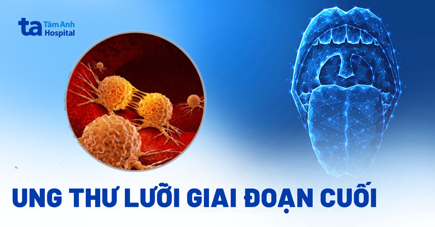 ung thư lưỡi giai đoạn cuối