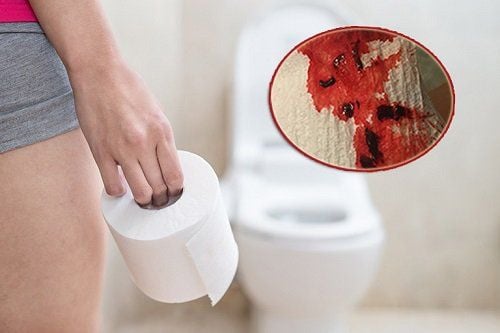 Nếu bạn bị viêm toàn bộ đại tràng xuất hiện triệu chứng tiêu chảy ra máu cần gặp bác sĩ ngay lập tức