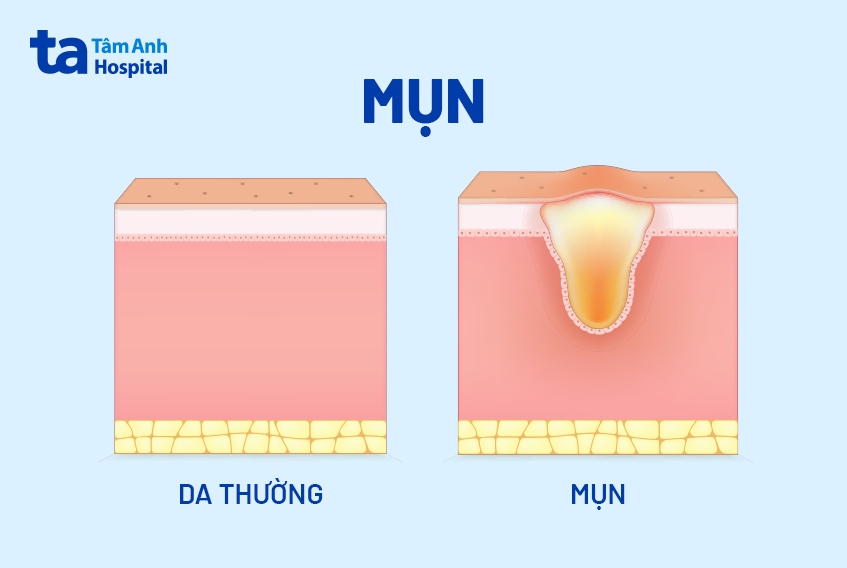 Mụn ẩn nằm bên dưới da thường khó phát hiện, chỉ sờ thấy cộm trên da