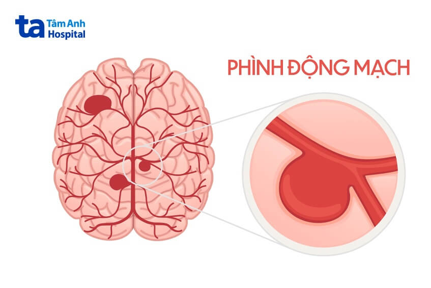 mô tả bệnh phình động mạch máu não