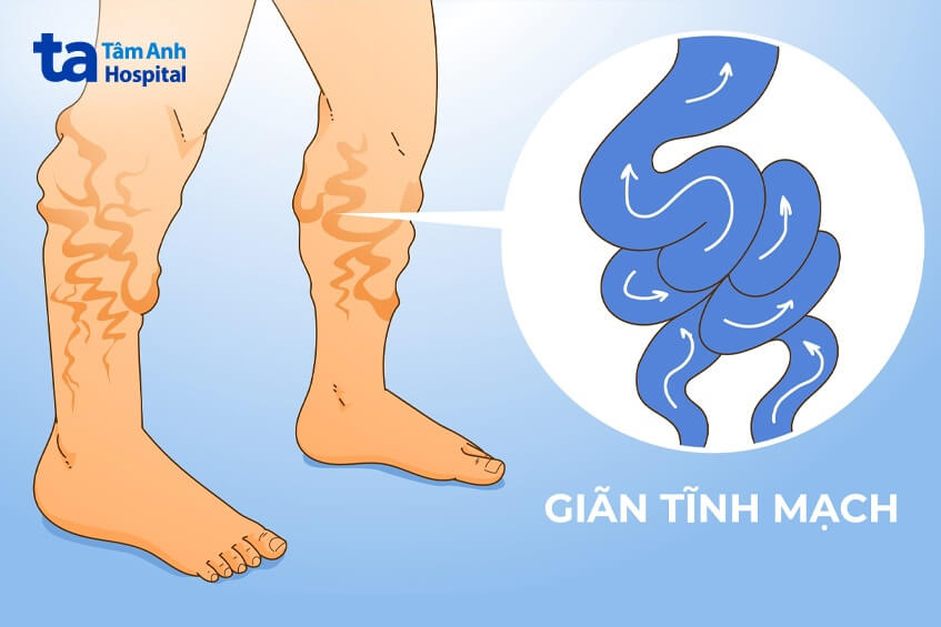 mô tả bệnh giãn tĩnh mạch máu ở chân