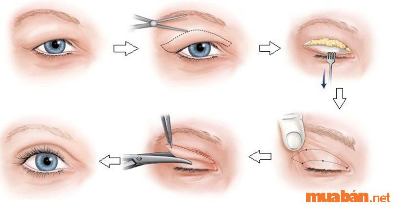 Thẩm mỹ cắt mí để tạo hình mắt bồ câu