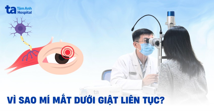 mí mắt dưới bị giật liên tục