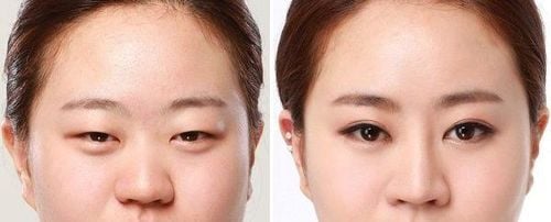 Sụt mí mắt xuất hiện mất đi tính thẩm mĩ