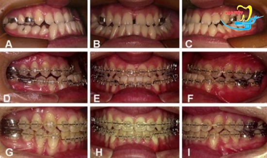 Bị móm phải làm sao và kết quả niềng răng móm