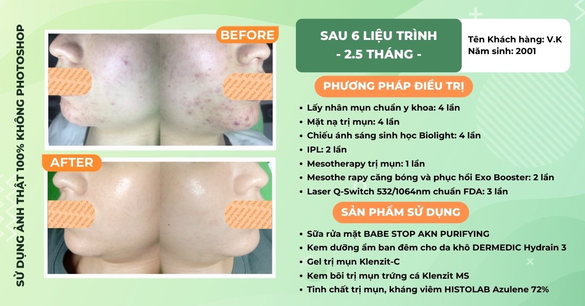 ca lâm sàng trị mụn quanh miệng