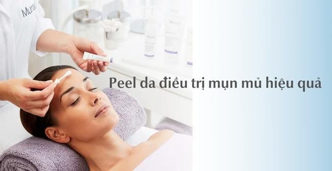 Peel da điều trị mụn mủ