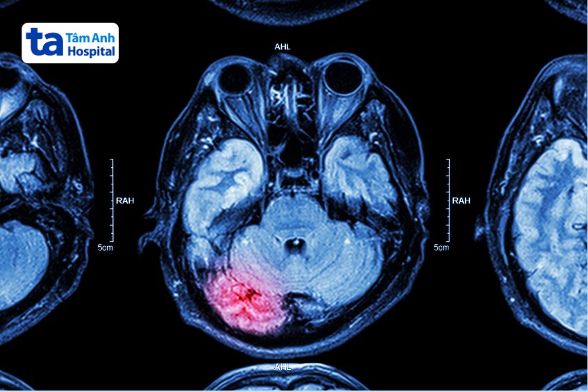 ảnh chụp mri não bộ bị tổn thương