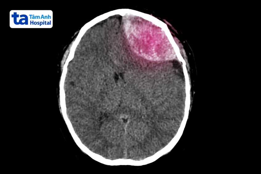 tụ máu não qua hình chụp mri