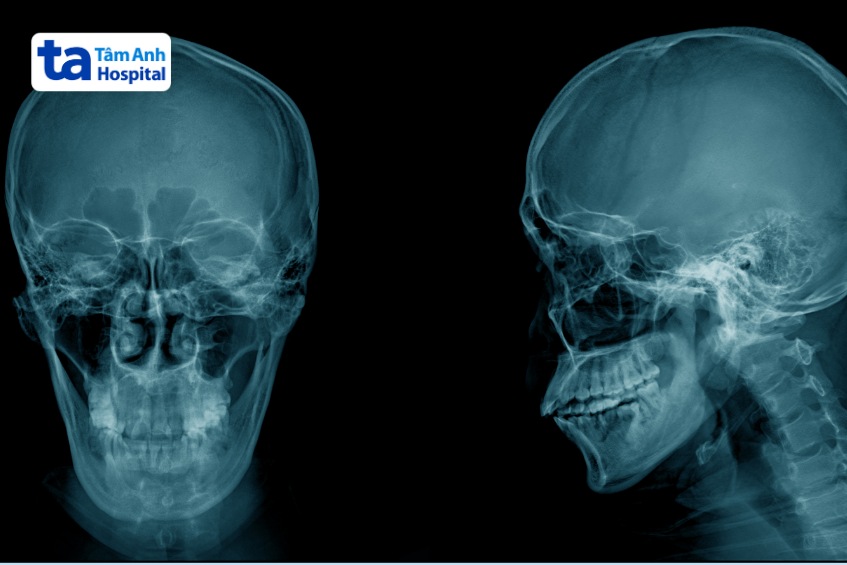 hình ảnh sọ não qua xquang
