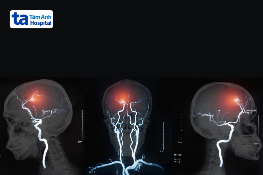 kỹ thuật chụp dsa chi tiết mạch máu não bộ