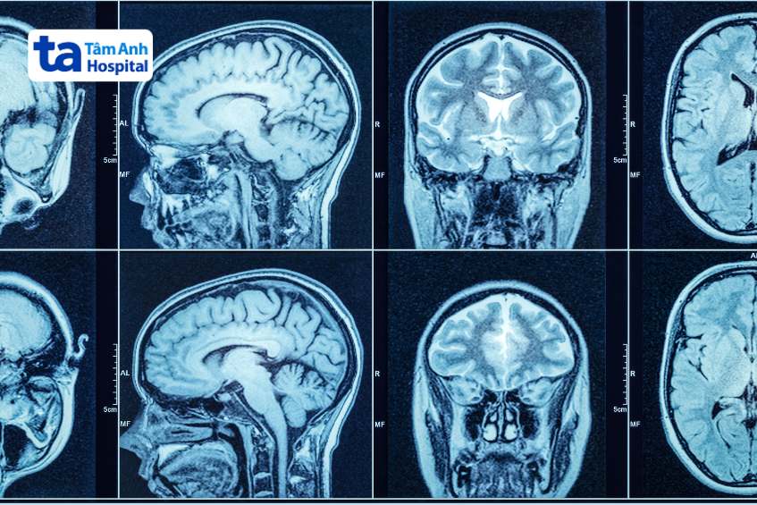 hình ảnh bộ não người mô phỏng 3 chiều mri